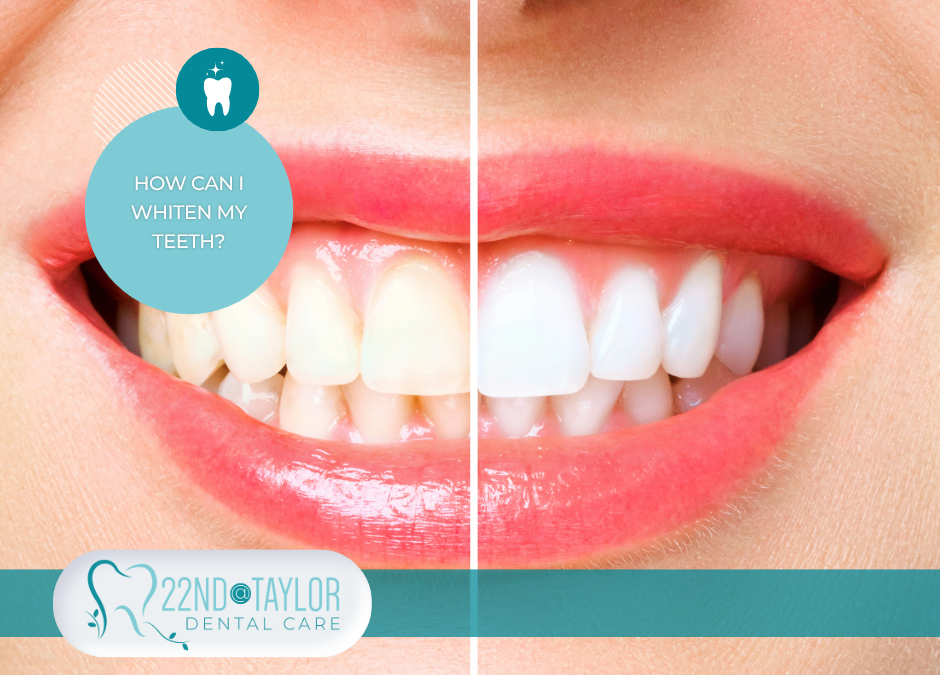 How Can I Whiten My Teeth?