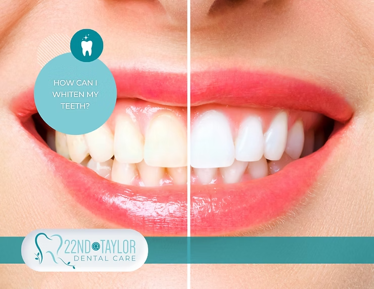 How Can I Whiten My Teeth?