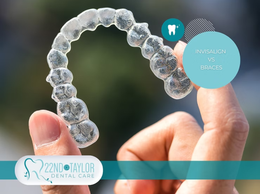 Invisalign Vs. Braces: Which is Right for You?