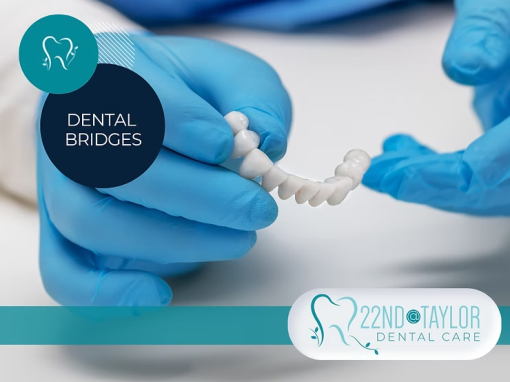 Common Questions About Dental Bridges: Answers from 22nd @ Taylor Dental Care Red Deer