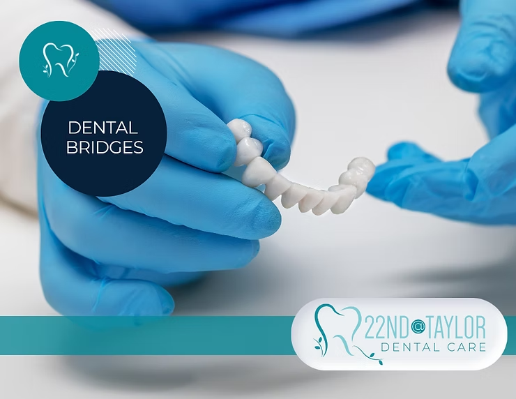 Common Questions About Dental Bridges: Answers from 22nd @ Taylor Dental Care Red Deer