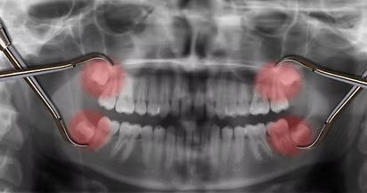 Wisdom Teeth Removal – FAQ